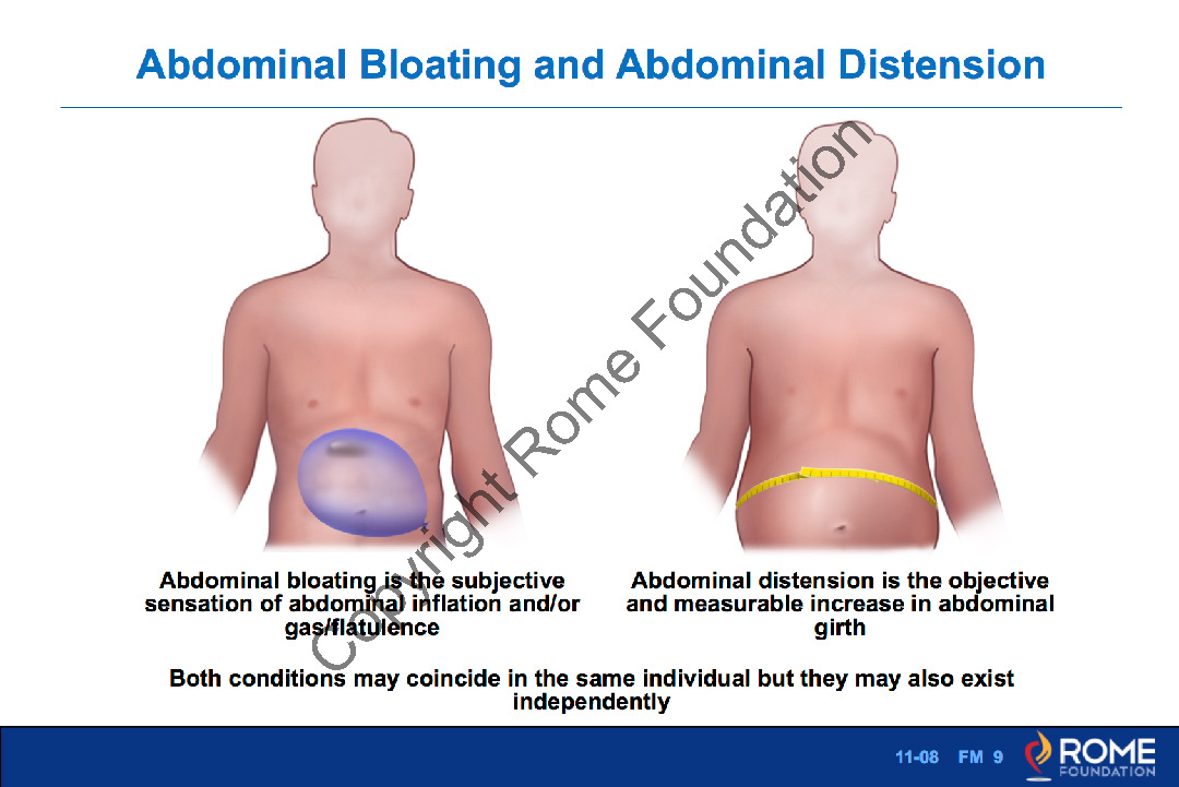 Abdominal bloating versus distension- A blog by Monash FODMAP