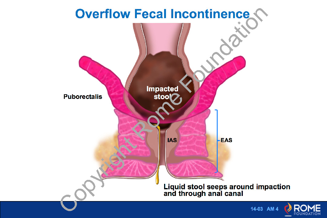 Faecal impaction with overflow
