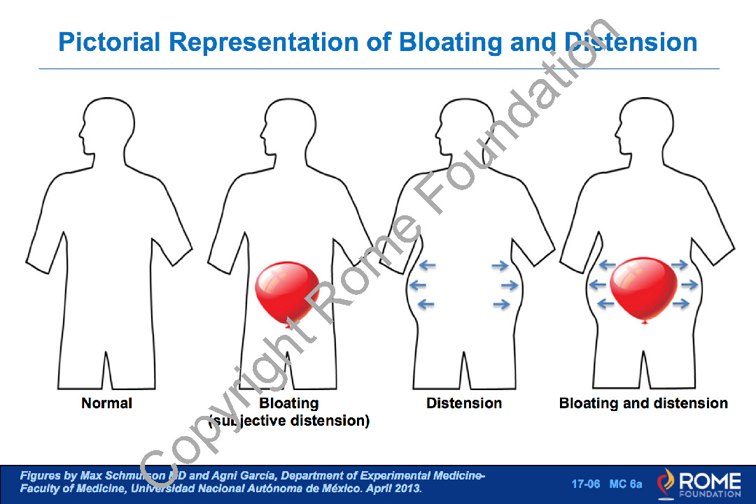Bloating and Distension: What's the Difference? - Rome Foundation